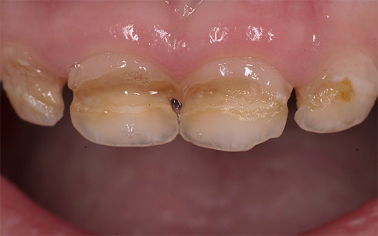 Un exemple de carie en bouteille: les parents doivent essayer de ne pas amener les dents de leur enfant dans un tel état, et dès les premiers signes de destruction, consulter un dentiste.
