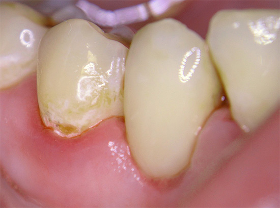 Coneixem les característiques de la càries cervical i els motius principals per la seva aparició a les dents ...