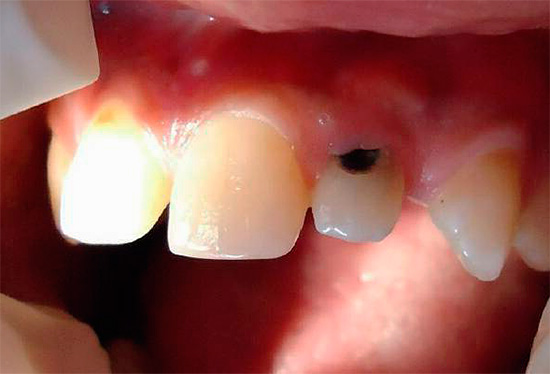 Et annet eksempel på en dyp karies lesjon i livmorhalsregionen i den øvre fremre tann.