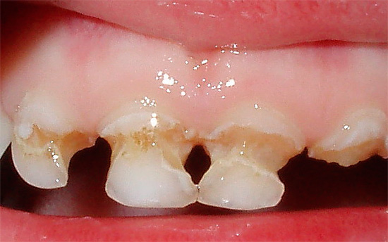 تسوس دائري للأسنان اللبنية