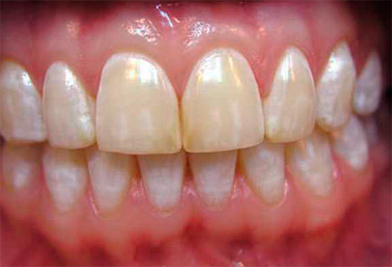Pri endemickej fluoróze môžu mať zuby tiež škvrny rôznych farieb, od bielej po hnedú.