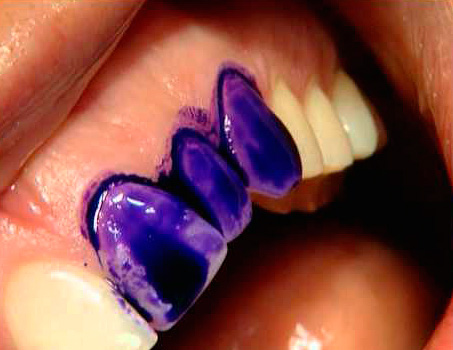 Specijalna boja tvrdo lakira samo tkiva zuba zahvaćena karijesom, dok u slučaju fluoroze i hipoplazije cakline ostaju neočišćena prilikom ispiranja otopine za bojenje.