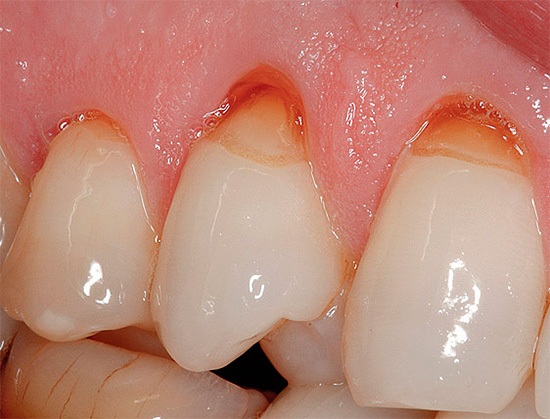 Na fotografii je uvedený príklad klinovitých defektov na horných zuboch.