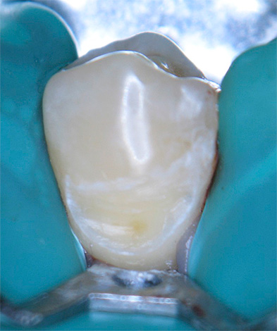 Servikal çürüklü bir dişin tedavi için hazırlanmasına bir örnek