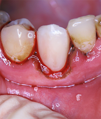 Installasjonen av en fylling i livmorhalsregionen kan være betydelig komplisert ved å få tannkjøttvæske og blod inn i arbeidsfeltet.