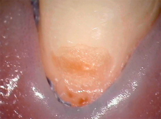En karies tannlesjon i livmorhalsregionen i det første utviklingsstadiet kan se ut som dette.