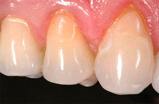 Et donc les dents s'occupent du traitement - les obturations établies dans la région du cou sont visibles.