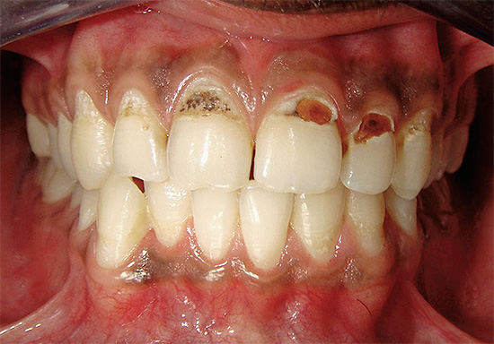 วิธีการมาตรฐานในการป้องกันการพัฒนาของโรคฟันผุจะมีประสิทธิภาพในกรณีของปากมดลูก