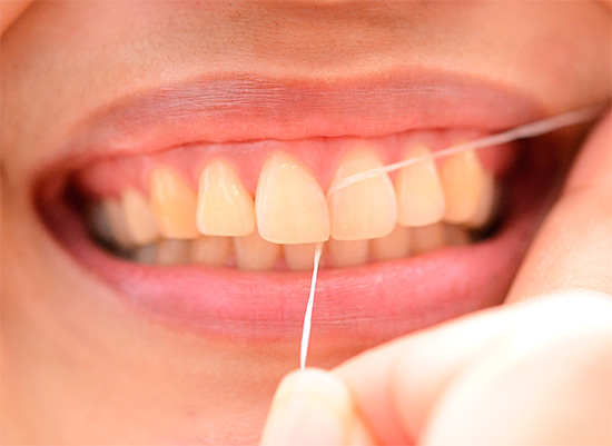 Penggunaan floss gigi membolehkan anda membersihkan ruang interdental secara berkesan, di mana kerosakan gigi sering boleh berkembang dengan terang-terangan.