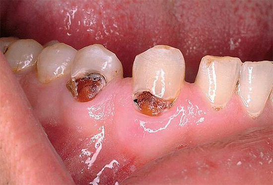 A toto je více zanedbaný případ krčního kazu, když je postižen dentin ležící pod sklovinou.