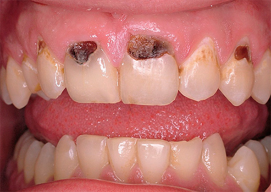 La càries cervical a les dents frontals pot arruïnar molt el somriure d’una persona.