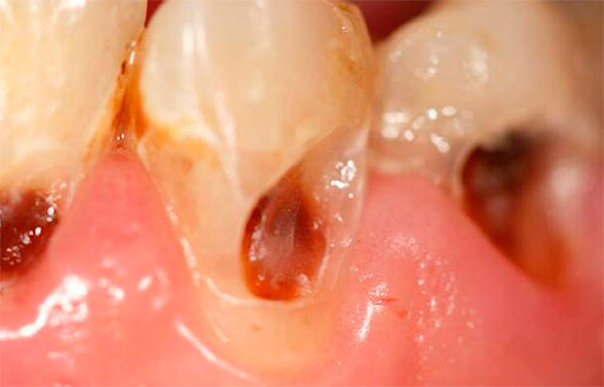 La foto mostra un exemple de càries cervicals profundes.