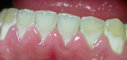 Cervical caries in the white spot stage: at this stage, urgent remineralizing therapy is necessary.