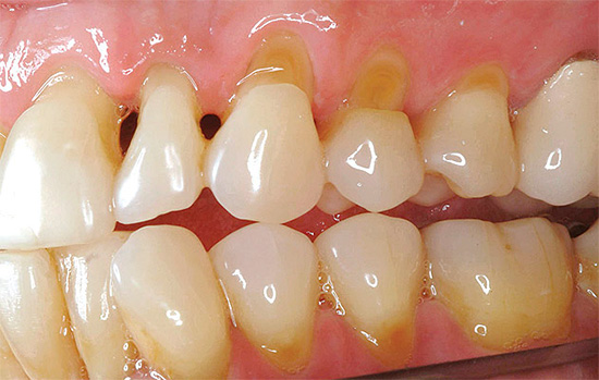 På grunn av tynningen av emaljen i livmorhalsregionen blir tannen veldig følsom for forskjellige typer irritanter, inkludert kald luft.