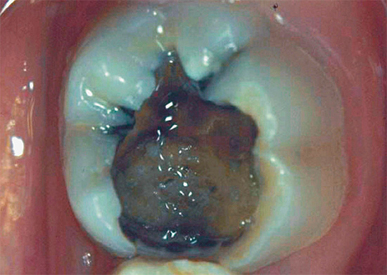 Fotografie ukazuje příklad hluboké kazivé dutiny na žvýkacím zubu.