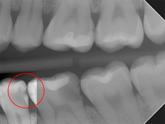 X-ray ini jelas menunjukkan kerosakan gigi oleh karies mendalam, yang tidak dapat dilihat dengan pemeriksaan visual yang mudah.