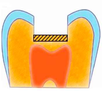 Per proteggere la polpa dagli effetti tossici del ripieno, viene prima installato un cuscinetto isolante sul fondo della cavità.