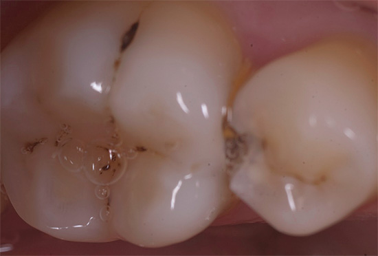 Deep caries on contact surfaces of teeth