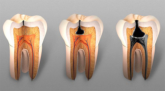 โรคฟันผุลึกแบบเฉียบพลันมักมีลักษณะเป็นทางเข้าแคบไปยังโพรงที่มีฟันผุและฐานกว้าง