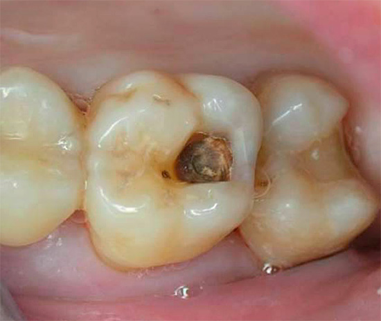 U chronických hlubokých zubních kazů, navzdory rozsáhlému zubnímu kazu, nemusí někdy dojít k bolesti.