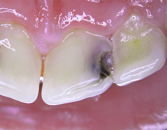 The photo shows deep caries on the front teeth