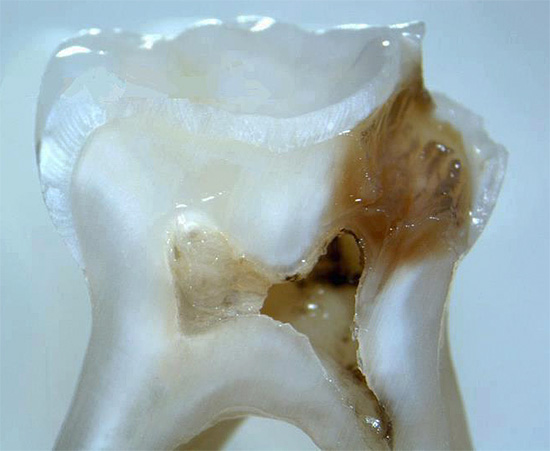 En skiva av en riktig tand med ett djupt karious hålrum, som når nästan till massakammaren.