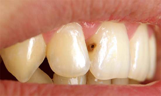 Deep caries on the front tooth