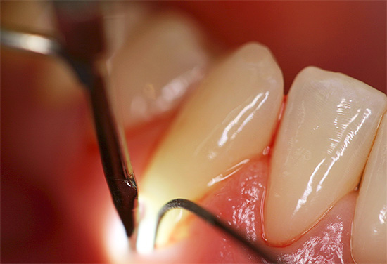 During the treatment of cement caries, a preliminary removal of mineral deposits under the gum may be required.