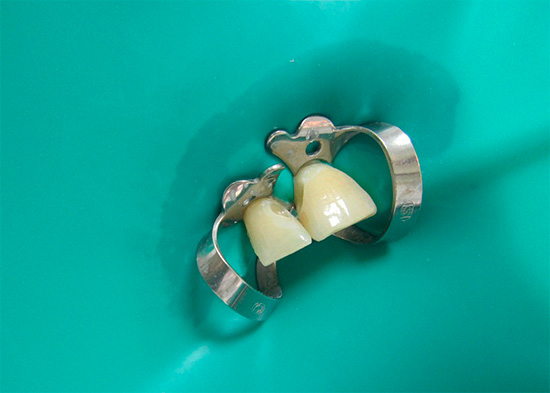 Durch die Verwendung von Kofferdamm (dünnes Gummimaterial) können Sie den Zahn vom Rest der Mundhöhle isolieren