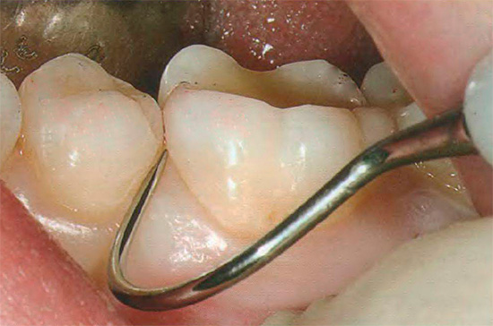 Un médecin expérimenté peut déterminer si vous avez des caries avec une sonde dentaire.