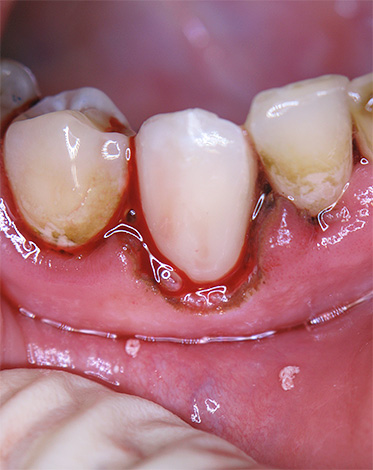 Ibland krävs skärning av en del av tandköttet om det stör behandlingsförfarandet.