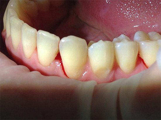 Bilden visar en tand med tandköttsdefekt före behandlingen