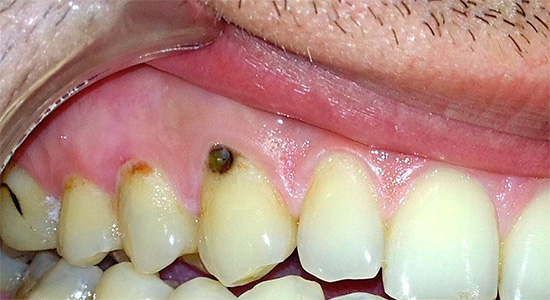 Často je zkomplikované poškození cementu kořene zubu spojeno s krčním kazem.