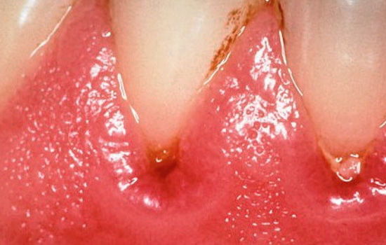 Vývoj mikroorganismů v kapse mezi dásní a zubem vede k zánětu měkkých tkání.