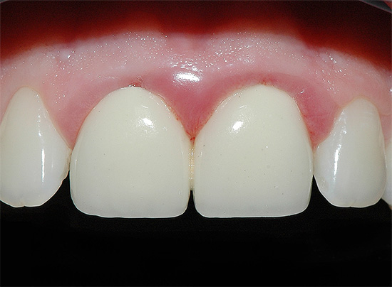 Incorrectly installed crowns can also cause cement caries.