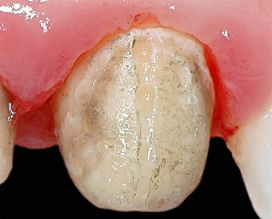 Zahnfleischerkrankungen im Bereich neben der Krone sind sehr gefährlich, wenn sie nicht behandelt werden.