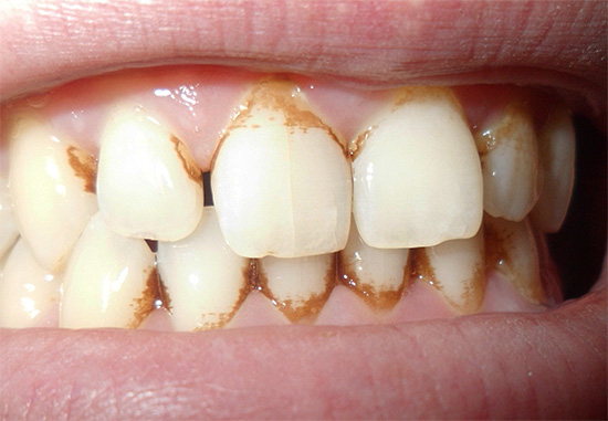 Acumularea plăcii în regiunea cervicală a dintelui poate provoca distrugerea carioasă a cimentului.