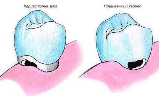 The picture shows the difference between cervical caries and carious destruction of the tooth root.
