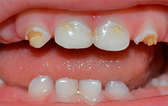 Млечните зъби на малките деца са особено уязвими от кариес, затова е важно всеки родител да има ясна представа как да предпази бебето от подобни проблеми.