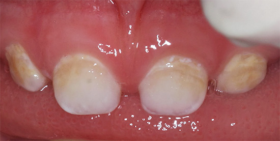 และการสลายตัวของฟันน้ำนมจึงดูในระยะเริ่มแรกของการพัฒนา - ยังไม่มีฟันผุลึก แต่เคลือบฟันนั้นปราศจากแร่ธาตุอยู่มาก