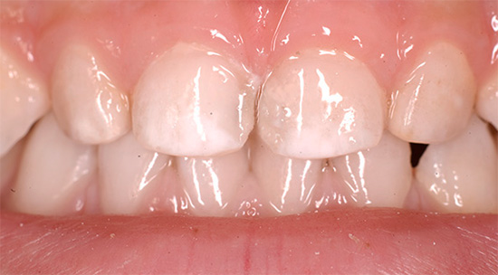 ตัวอย่างของการเคลือบฟันผลัดใบสีขาวเนื่องจากการปราศจากแร่ธาตุ