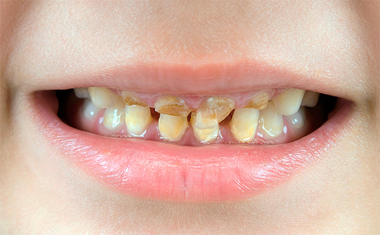 По правилу, у недостатку одговарајуће оралне хигијене, каријес одмах погађа многе бебине млечне зубе.