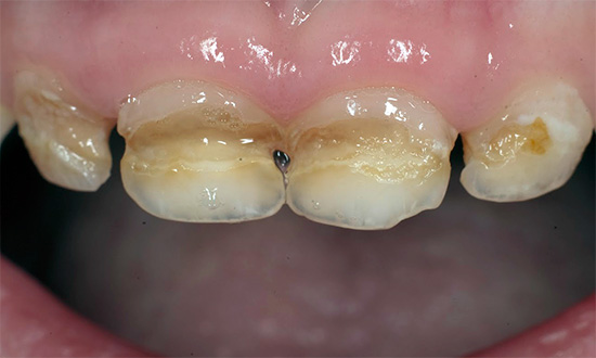 Kruhový úpadok listnatých zubov