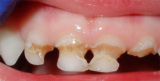 S tímto stavem zubů se jejich korunová část může snadno zlomit.