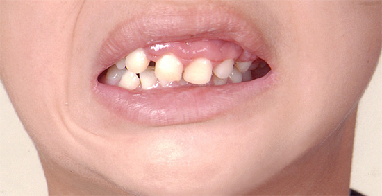 La perte prématurée des dents primaires entraîne souvent une malocclusion et même un changement de forme du visage.