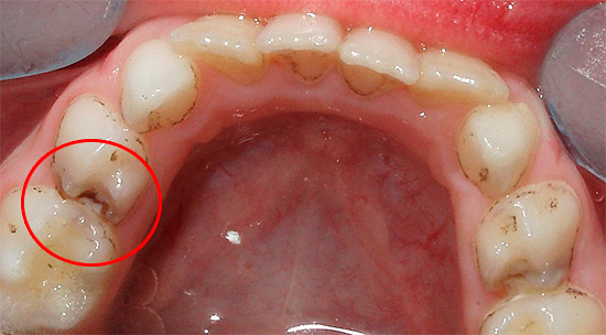Con la carie profonda, il dolore ai denti da latte può verificarsi anche a seguito di un semplice contatto meccanico con alimenti solidi.