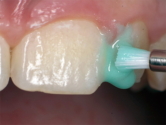 Hari ini, teknologi ICON yang dipanggil, yang tidak memerlukan penyediaan gigi dengan gerudi, digunakan secara meluas untuk merawat kerosakan gigi.