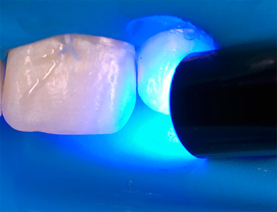 Ang inilapat na polymer cures na may ultraviolet light.