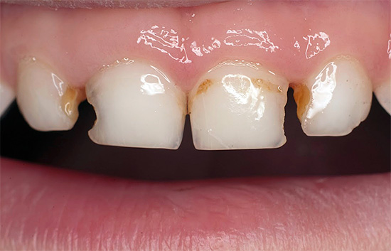 Zubný kaz na predných zuboch dieťaťa