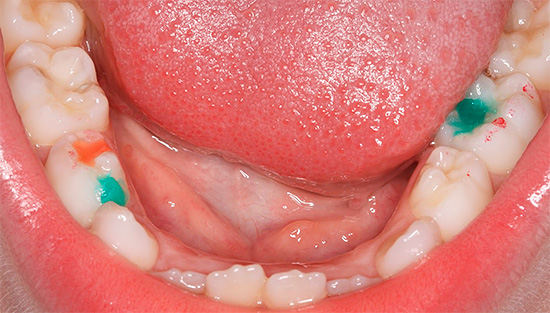 Utilizarea umpluturilor colorate în dinți de lapte permite copilului să fie interesat și motivat pentru tratament.